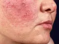 Haut brennt nach Creme? Ursachen & Soforthilfe vom Profi